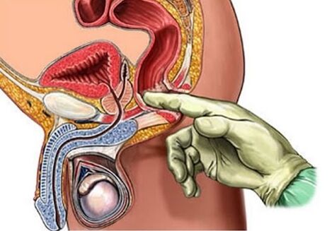 Masaža prostate