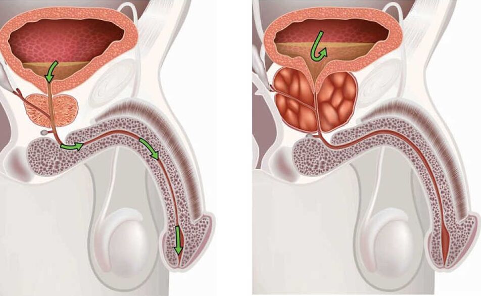Upala prostate