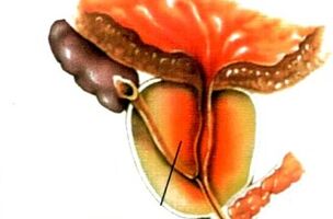 Što je prostatitis kod muškaraca