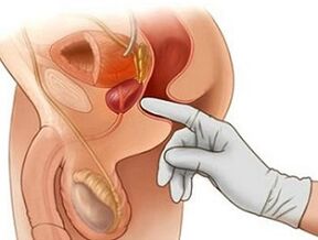 Masaža prostate za liječenje prostatitisa kod muškaraca