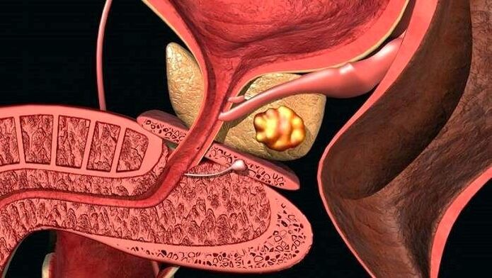 Naslage kamenca u prostati s kalkuloznim prostatitisom