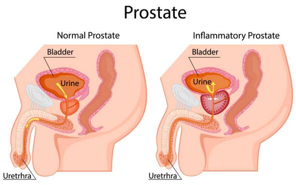 zdrava i upaljena prostata