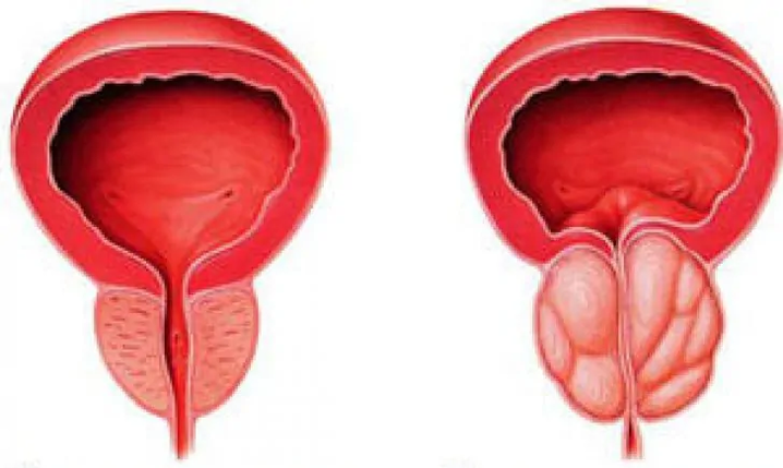 Normalna prostata (lijevo) i upaljeni kronični prostatitis (desno)
