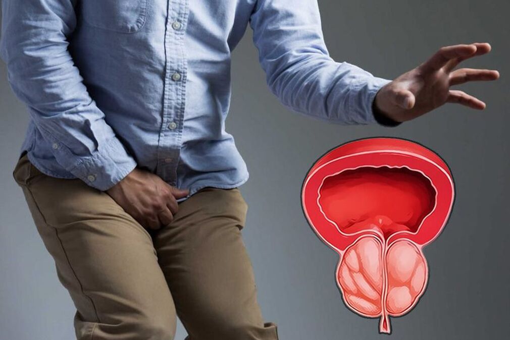 akutna prostata kod muškaraca