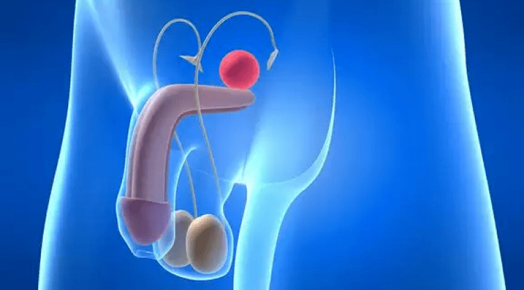 Prostatitis je upala prostate kod muškaraca koja zahtijeva složeno liječenje